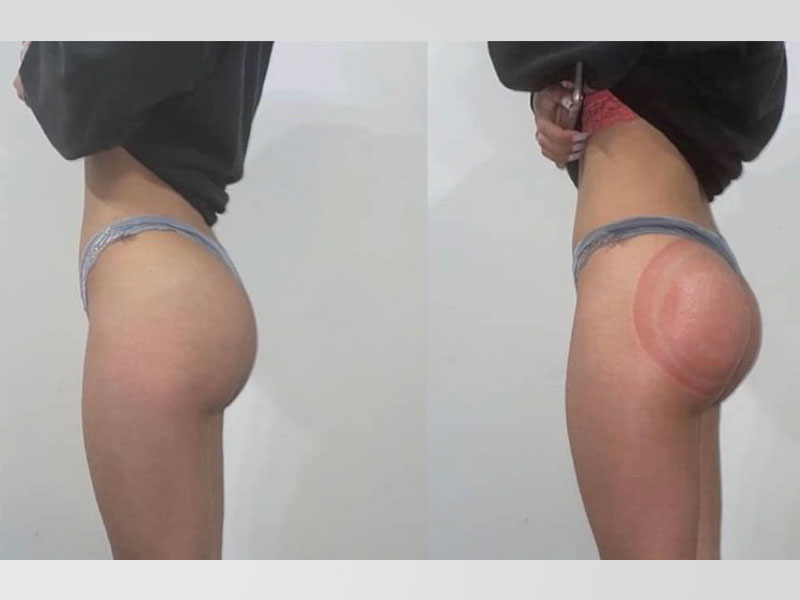 BBL Butt Lifting Therapy
